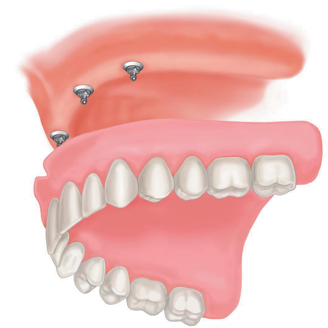over dentures