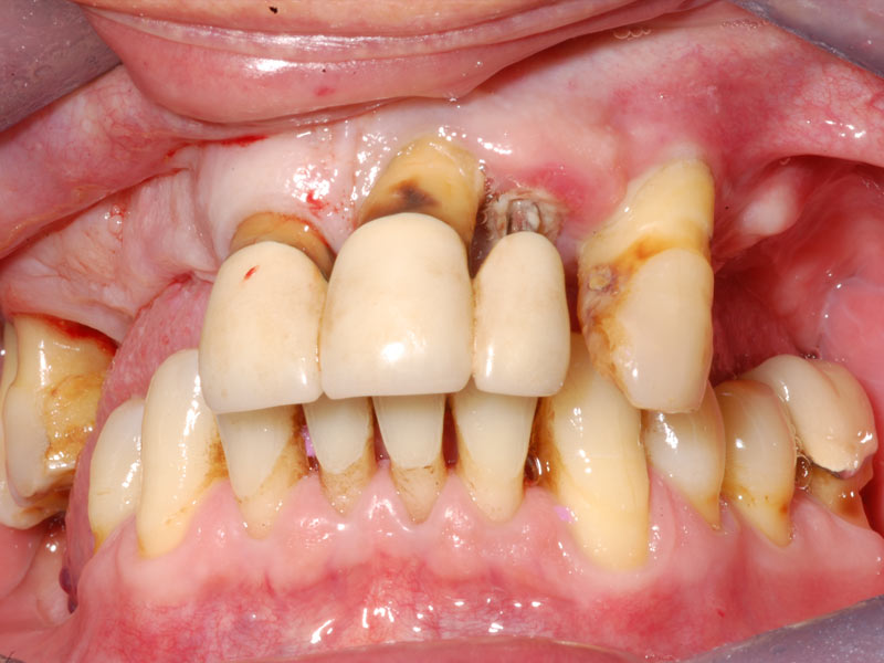 before picture of patient with perio disease